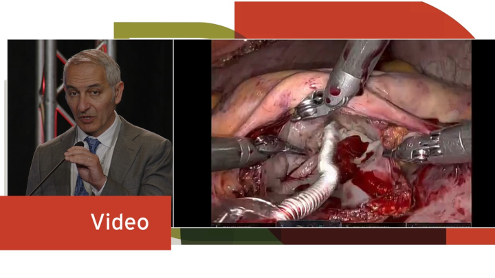 Live Robotic Mitral Valve Repair | Sloane Guy, MD, MBA, FACS, FACC